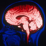 Brain-Imaging Studies Hampered by Small Data Sets, Study Finds