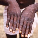 African scientists baffled by monkeypox cases in Europe, US