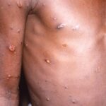 Africans see inequity in monkeypox response elsewhere