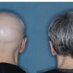 F.D.A. Approves Alopecia Drug That Restores Hair Growth in Many Patients