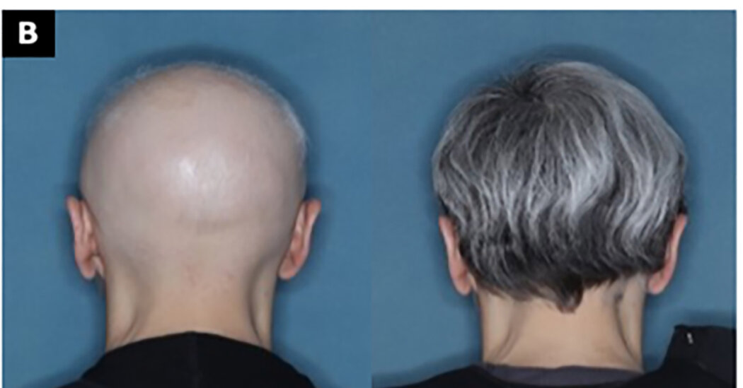 F.D.A. Approves Alopecia Drug That Restores Hair Growth in Many Patients