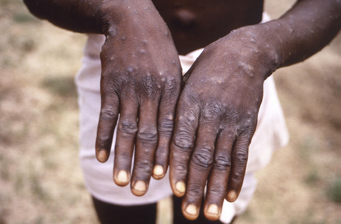 UN health agency chief declares monkeypox a global emergency