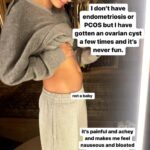 Hailey Baldwin Bieber Has an Ovarian Cyst the ‘Size of an Apple’